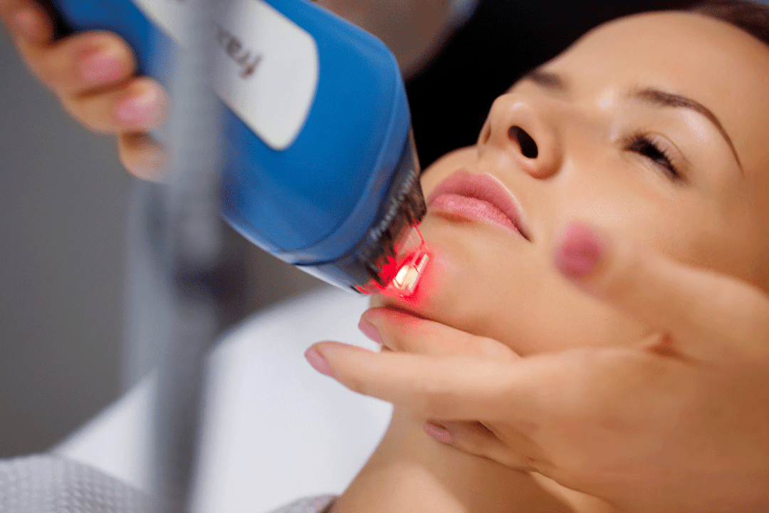 ласерско подмлађивање коже лица